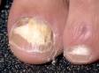 White nails accompanied by slightly elevated lesions are typical of onychomycosis (fungal nail infections).