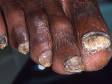This image displays a thickening of the nails and accumulation of scaly debris below the nail typical of onychomycosis (a fungal infection of the nails).