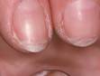 This image displays the plate-like splitting of the nail in onychoschizia.