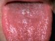 Oral candidiasis (thrush). The white, slightly elevated lesions appear to be "sitting" on the tongue surface.