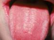 Oral candidiasis (thrush) frequently has a white patch at the middle of the tongue, as displayed in this image.