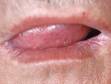 This image displays oral candidiasis (yeast infection) at the corners of the mouth.