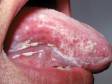 Thrush (Oral Candidiasis) in Adults: Condition, Treatments, and Pictures - Overview | skinsight