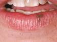 This image displays a typical brown oral melanotic macule, a flat, small lesion.