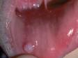This image displays a mucocele inside the lip.