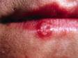 This image displays the fluid-filled blister typical of herpes.