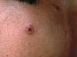 This image displays a blister with a central depression, typical of herpes simplex.