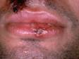 This image displays severe inflammation with skin ulcers and bloody crusts as seen on the right upper lip of this immunocompromised person.