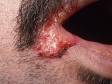 This image displays an ulcer from a herpes infection, which is typical of an immunocompromised person.