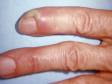 Nail-fold swelling and large pus-filled lesions are typical of a bacterial paronychia.