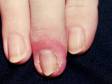 This image displays cracks and swelling around the nail typical of chronic paronychia.