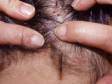 In this scalp infested with head lice, there are 2 scabs from scratching and a few white nits on the hair shaft (which look like flakes of dandruff but are actually glued to the hair).