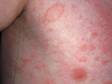 In the displayed image, the large red circle on the upper chest is the "herald patch" of pityriasis rosea.