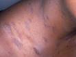 In people with darker skin, pityriasis rosea can have a deeper color, as displayed here.