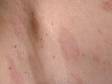 This image displays very fine, scaly, oval, slightly elevated lesions typical of pityriasis rosea.