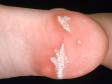This image displays a recurrent wart on the heel and a scar due to surgery for removal of original wart.