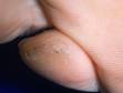 This image displays a typical plantar wart with clotted capillaries appearing as small, black dots on the skin.