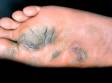 Plantar warts can look like giant calloses, as displayed in this image.