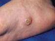 This image displays the thick scale associated with plantar warts (warts on the feet).
