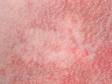 This skin discoloration, due to chronic sun damage, has lacy areas of redness from dilated blood vessels.