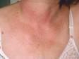 Poikiloderma of Civatte typically occurs on the neck and, in a v-shaped distribution, on the upper chest that includes redness and a "chicken-skin" appearance.