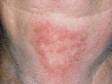This image displays a flat, pink discoloration on the neck typical of chronic sun exposure.