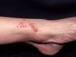 This image displays poison ivy dermatitis where the allergen touched the skin.