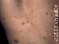 Don T Ignore These Dark Spots On Your Skin Skinsight