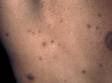 This image displays post-inflammatory hyperpigmentation (dark flat marks left after a skin problem has healed).