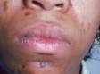 Dark skin spots often follow acne lesions in Black patients.