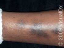 Dark Spots On Legs Skinsight