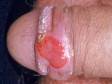 This image displays a chancre, and ulcer of primary syphilis.