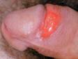 This image displays an ulcer of primary syphilis.