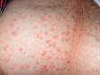 In pseudomonas folliculitis (hot tub folliculitis), the red skin lesions are often quite large, as displayed in this image.