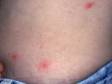 This image displays the red areas typical of pseudomonas folliculitis (hot tub folliculitis).