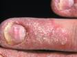 Psoriasis involving the fingernails may cause an irregular nail plate as well as separation of the nail from the nail bed (onycholysis). This individual also has psoriasis of the skin around the nail.