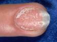 This image displays pits, roughness, and lifting of the tip of the nail tip typical of psoriasis of the nail.