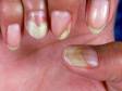 This image displays yellow, lifted nails from onycholysis, which is frequent in psoriasis.