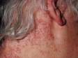 Psoriasis may involve large areas of scaling, such as on the neck and scalp.