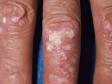 These small bumps and slightly elevated lesions have the typical white scale of psoriasis.