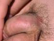 The scaling typical of psoriasis is also seen on the genitals.