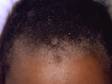 This image displays dry, scaly areas of the scalp typical of psoriasis.