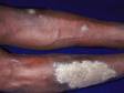 This image displays psoriasis, which can develop a thick, white scale.