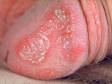 This image displays the scaly redness of the skin typical of psoriasis.