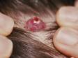 Pyogenic granulomas can occur quickly on almost any part of the body. They are typically red to deep red and bleed easily.