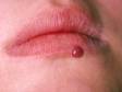 Pyogenic granulomas appear and enlarge in days, and they are usually deep red and sometimes bleed easily.