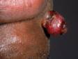 This image displays a pyogenic granuloma, which has grown far off the skin surface and bleeds when traumatized.