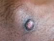 A pyogenic granuloma often has a small "collar" of normal skin around the base, as displayed in this image.