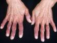 This image displays fingers that are purple and chronically cold due to Raynaud's disease.