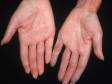 This image displays the hands of a person with scleroderma and a severe case of Raynaud's disease.